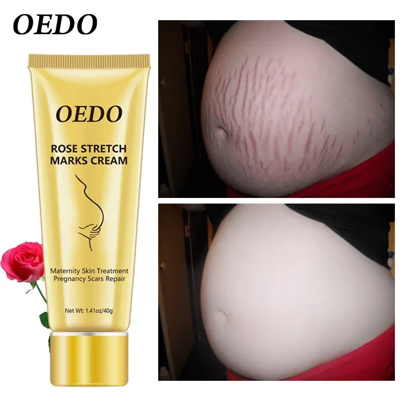 OEDO Stretch Mark Cream